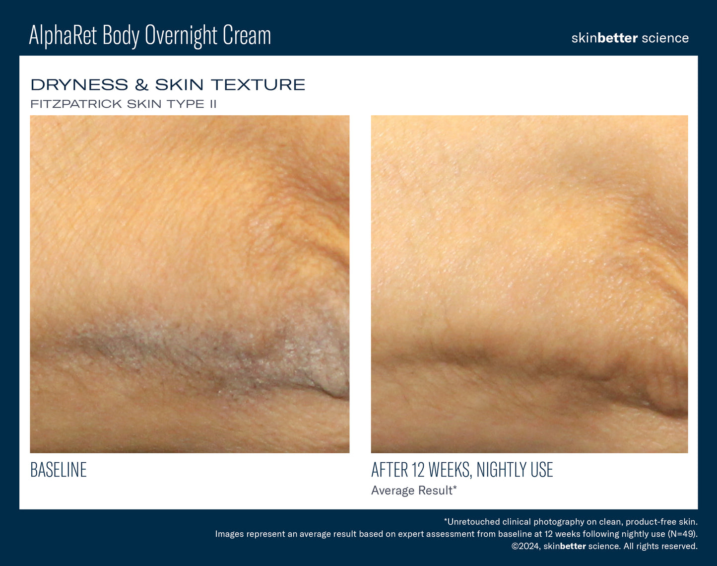 AlphaRet Body Overnight Cream 150ml