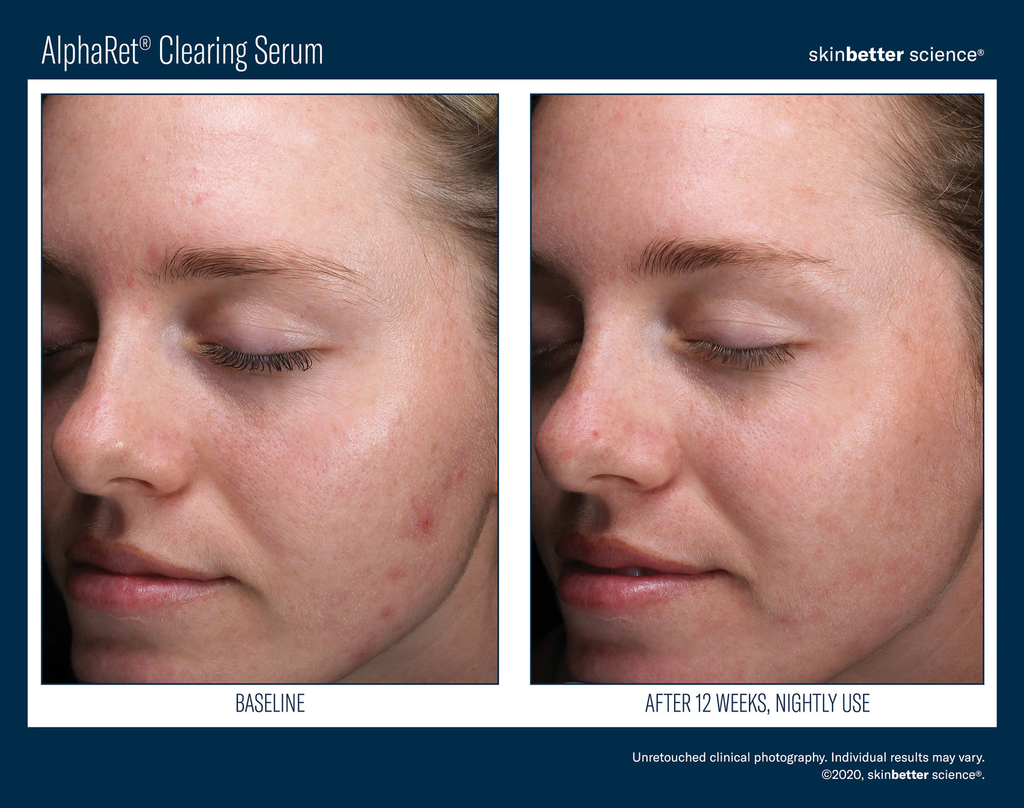 AlphaRet Clearing Serum 30ml