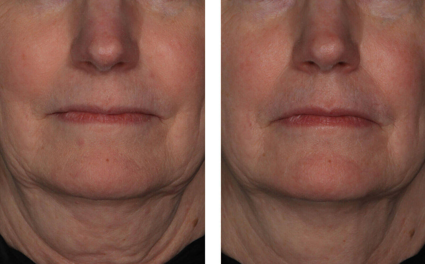 InterFuse Treatment Cream FACE & NECK 30ml